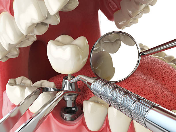 Best Emergency Dentist for Knocked-Out Tooth in Inman, SC